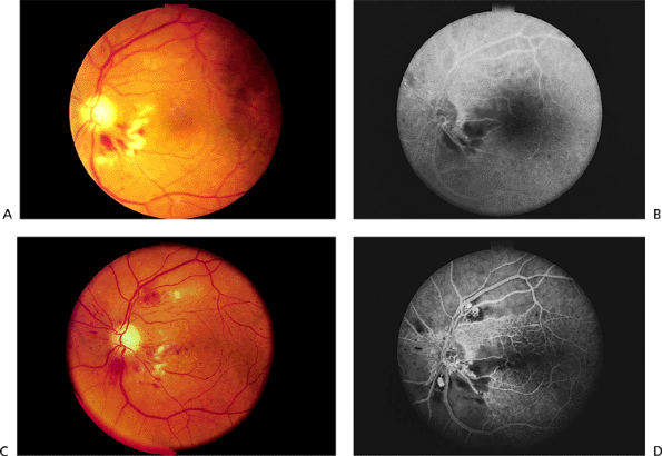 5 Retinal Vascular Disease The Wills Eye Hospital Atlas Of Clinical